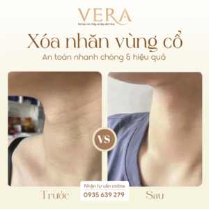 Đánh bay nếp nhăn, xóa mờ dấu vết thời gian tại Vera Spa